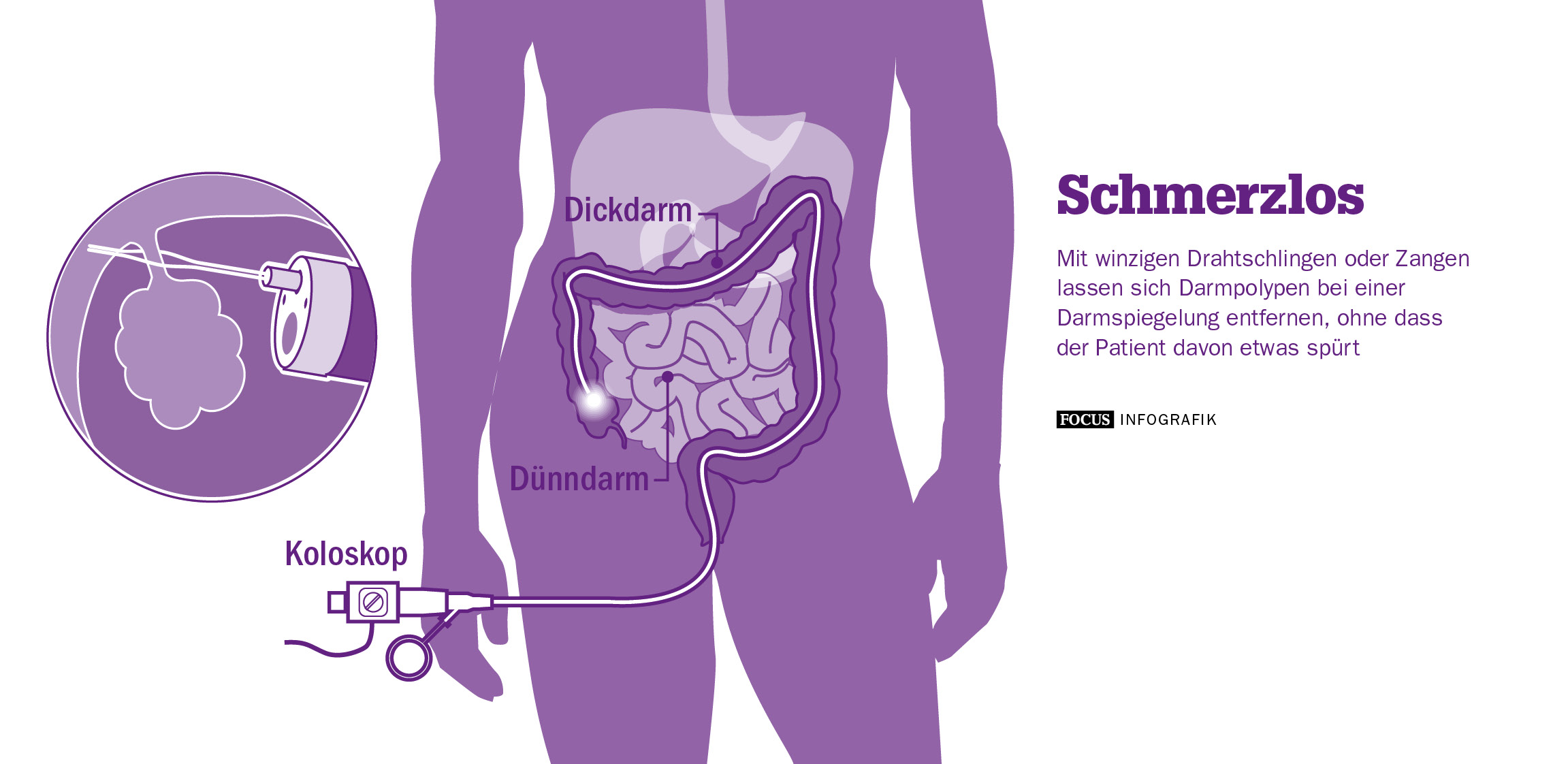 Schmerzlos: Die Koloskopie.