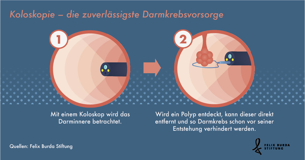 Die zuverlässigste Darmkrebsvorsorge